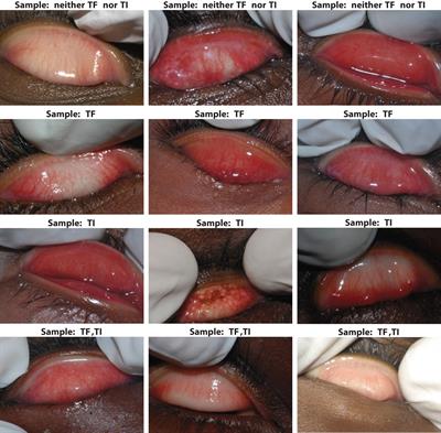 Active trachoma: enhancing image classification using pretrained SOTA models and explainable AI